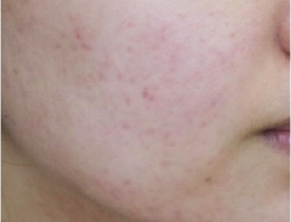 ニキビ治療前