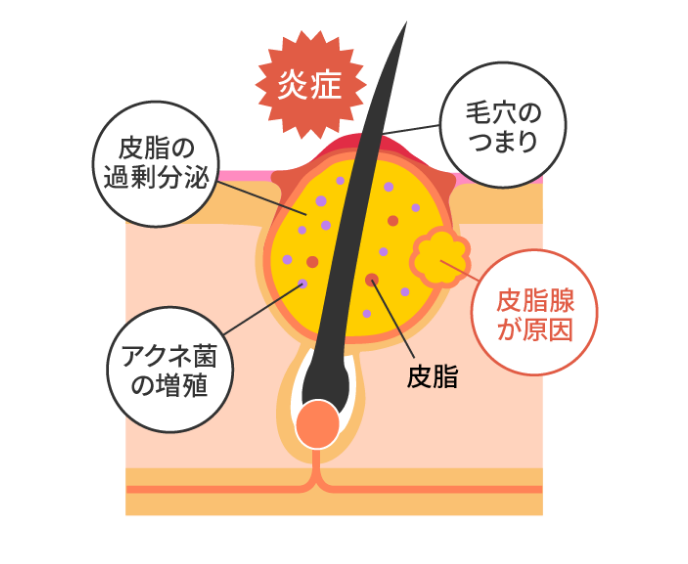 毛穴のトラブル